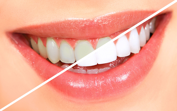 best teeth whitening strips
